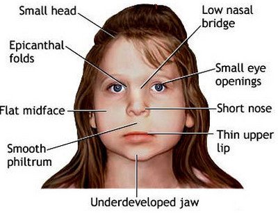 Facial Features Of Fas 89