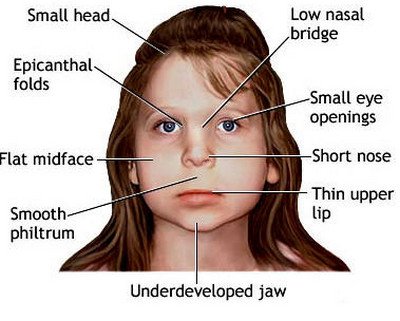 sinus congestion united kingdom