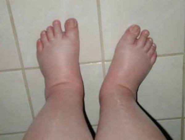 What Cause Swollen Feet During Pregnancy