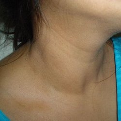 hives-like rash with hypothyroidism - Thyroid Disorders ...