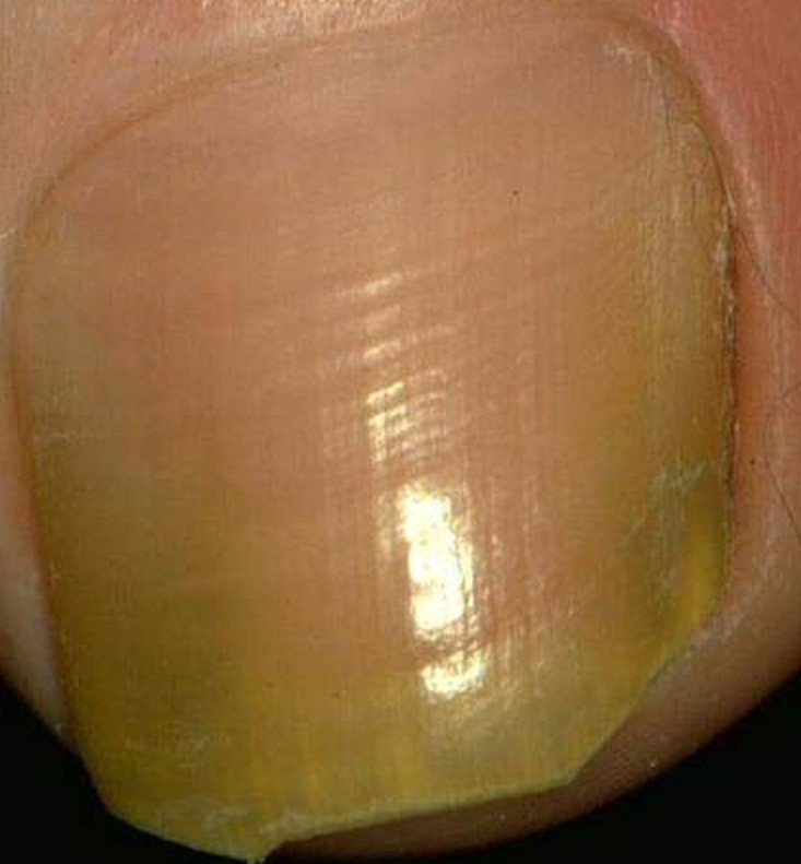 Toenail Fungus Disease