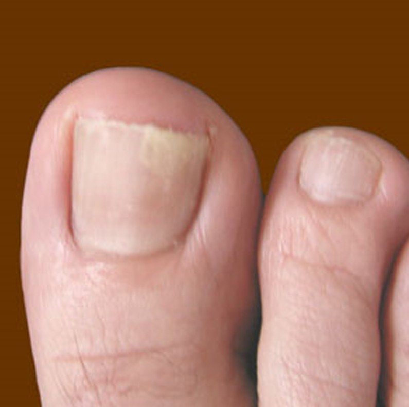 What Causes Foot And Toenail Fungus