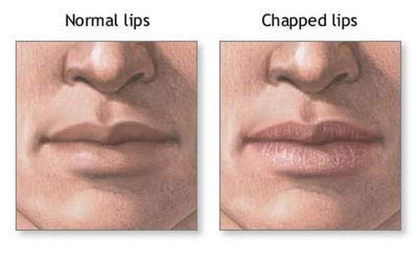 Chapped Lips Causes Symptoms Diagnosis Treatment Remedies 