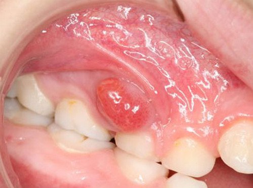 home remedies for tooth infection