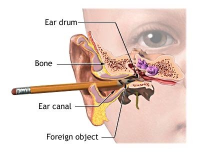 clogged ear picture