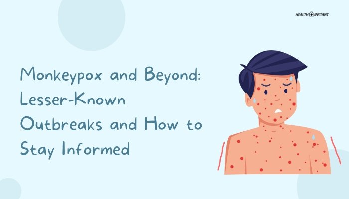 Monkeypox and Beyond: Lesser-Known Outbreaks and How to Stay Informed