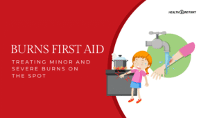 Burns First Aid- Treating Minor and Severe Burns on the Spot